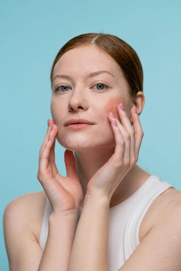 Top Rosacea Skincare Tips from an Irish Expert